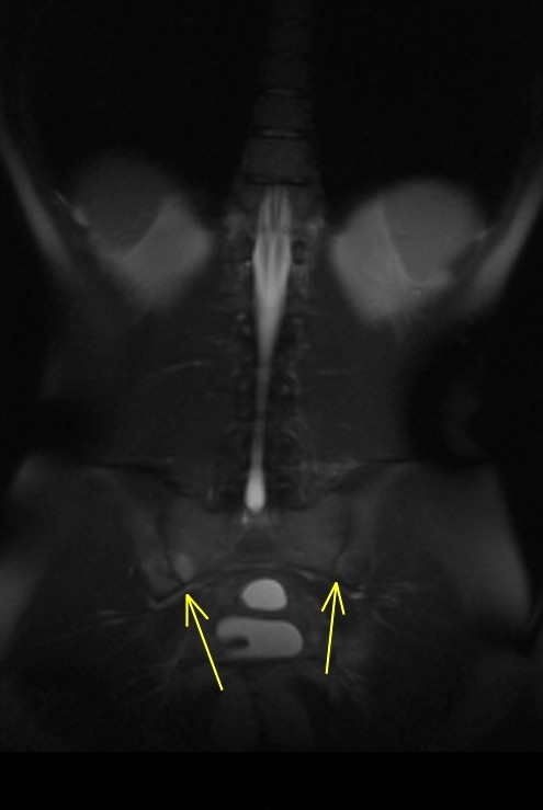 Figure 4 for case Enteropathic arthropathy